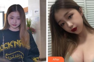 合肥恒美整形醫(yī)院王廣亮整形價格表附假體隆胸案例展示