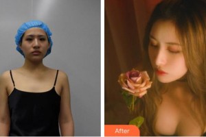 合肥恒美整形醫(yī)院李曉東整形價格表附脂肪填充胸部案例展示