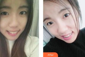 合肥麗人女子醫(yī)院中韓整形美容中心尹杜龍整形價格表附口腔矯正案例展示