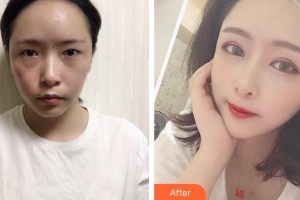 合肥恒美整形醫(yī)院汪信泮整形價格表附雙眼皮案例展示