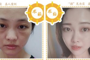 合肥伊爾醫(yī)療美容診所楊乂整形價格表附埋線提升案例展示