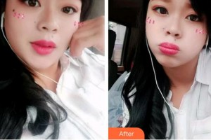 合肥華美整形美容醫(yī)院支梅整形價格表附牙齒隱形矯正案例展示