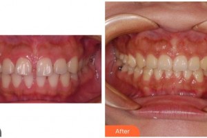 合肥麗人女子醫(yī)院中韓整形美容中心魏華生整形價格表附牙齒正畸案例展示