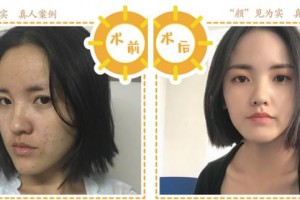 合肥天鵝湖整形美容醫(yī)院葉麗琴整形價格表附埋線提升案例展示