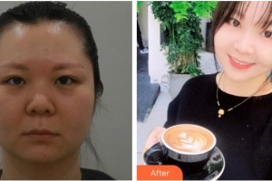 合肥華美整形美容醫(yī)院鄭盛謨整形價格表附多方面部埋線提升案例展示