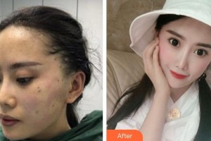 合肥麗人女子醫(yī)院中韓整形美容中心樸洪龍整形價格表附面部埋線提升案例展示