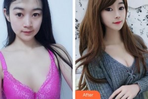 合肥麗人女子醫(yī)院中韓整形美容中心白承燦整形價格表附隆胸案例展示