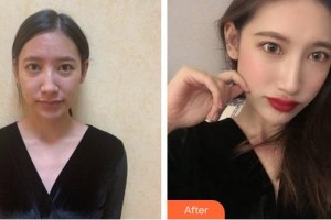 合肥大韓整形美容醫(yī)院申洪國(guó)整形價(jià)格表附肋軟骨隆鼻案例展示