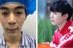 合肥申誠(chéng)整形美容醫(yī)院魏有志整形價(jià)格表附鼻部綜合案例展示
