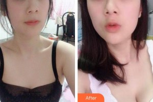 合肥第一人民醫(yī)院整形美容分院青紀(jì)鴻整形價(jià)格表附自體脂肪隆胸案例展示