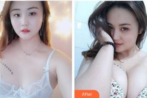 合肥伊爾醫(yī)療美容診所鄭孝威整形價(jià)格表附自體脂肪隆胸案例展示