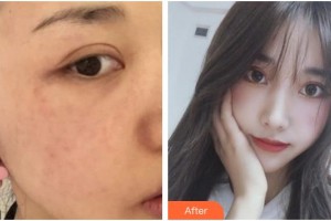 合肥大韓整形美容醫(yī)院張厚感整形價(jià)格表附激光美膚激光案例展示