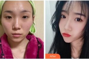 合肥大韓整形美容醫(yī)院衛(wèi)愛俠整形價(jià)格表附顴骨內(nèi)推案例展示