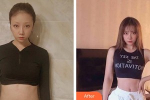 合肥大韓整形美容醫(yī)院張靜整形價(jià)格表附疤痕案例展示