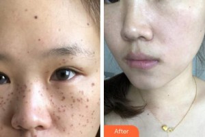 合肥丹鳳朝陽(yáng)婦科醫(yī)院整形美容外科李淑珂整形價(jià)格表附祛斑案例展示