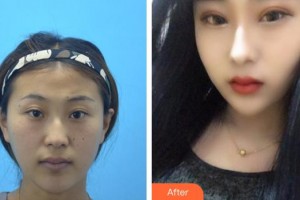 合肥崔勁松醫(yī)療美容診所崔向葵整形價(jià)格表附眼部案例展示