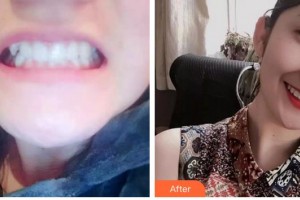 合肥恒美整形醫(yī)院趙家鳳整形價(jià)格表附牙齒陶瓷矯正案例展示