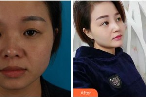 合肥恒美整形醫(yī)院廖亞敏整形價(jià)格表附耳軟骨復(fù)合隆鼻案例展示