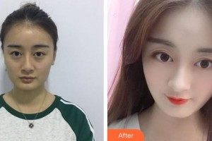 合肥亞典整形美容醫(yī)院吳邊整形價(jià)格表附耳軟骨復(fù)合隆鼻案例展示
