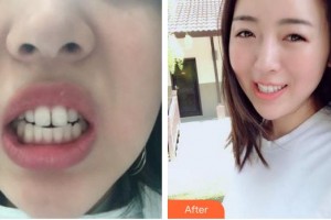 合肥艾雅整形美容醫(yī)院仇凌波整形價(jià)格表附隱形托槽矯正案例展示