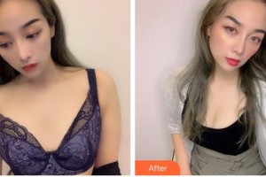 合肥天鵝湖整形美容醫(yī)院余式普整形價(jià)格表附自體脂肪隆胸案例展示