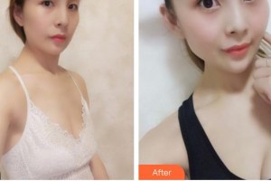 合肥天鵝湖整形美容醫(yī)院康學(xué)培整形價(jià)格表附自體脂肪隆胸案例展示