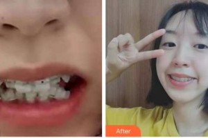 合肥崔勁松醫(yī)療美容診所張敦苗整形價(jià)格表附牙齒陶瓷矯正案例展示