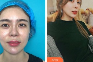 合肥福華醫(yī)療美容醫(yī)院楊富春整形價(jià)格表附眼部綜合案例展示