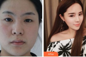 合肥臺(tái)美醫(yī)療美容門(mén)診部莊堅(jiān)文整形價(jià)格表附雙眼皮案例展示