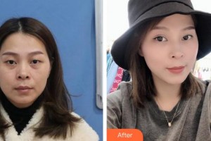 合肥童顏堂醫(yī)療美容醫(yī)院吳櫟佳整形價(jià)格表附眼部整形案例展示