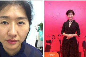 合肥童顏堂醫(yī)療美容醫(yī)院閆美華整形價(jià)格表附眼部修復(fù)案例展示