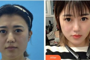 合肥童顏堂醫(yī)療美容醫(yī)院整形價(jià)格表附埋線提升案例展示