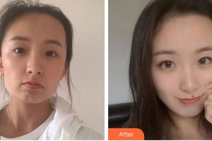 合肥臺(tái)美醫(yī)療美容門(mén)診部羅世恩整形價(jià)格表附埋線提升案例展示