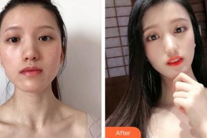 合肥光美醫(yī)療整形美容醫(yī)院周家琴整形價(jià)格表附激光美膚激光案例展示