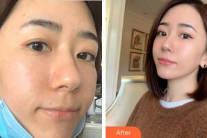 合肥光美醫(yī)療整形美容醫(yī)院范梅整形價(jià)格表附激光美膚激光案例展示