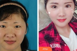 合肥臺(tái)美醫(yī)療美容門(mén)診部劉建龍整形價(jià)格表附切開(kāi)雙眼皮案例展示