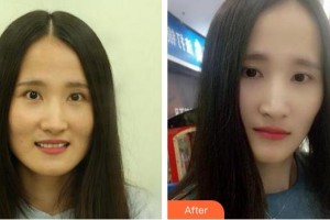 合肥壹美尚美容醫(yī)院張慧烽整形價(jià)格表附牙齒陶瓷矯正案例展示