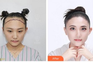 合肥源森美容整形外科診所曹守己整形價(jià)格表附種植發(fā)際線案例展示