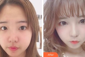 合肥翡睿醫(yī)療美容門(mén)診部楊森整形價(jià)格表附眼部綜合案例展示