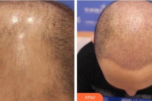 合肥叢生醫(yī)療美容門(mén)診部王順霞整形價(jià)格表附頭頂加密種植案例展示