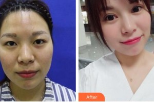 合肥美舒雅醫(yī)療美容診所高偉整形價(jià)格表附眼部綜合案例展示