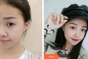 合肥美舒雅醫(yī)療美容診所李亞會(huì)整形價(jià)格表附切開雙眼皮案例展示