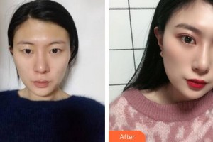 合肥美舒雅醫(yī)療美容診所尹洋整形價(jià)格表附切開雙眼皮案例展示