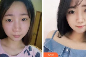 合肥玉顏醫(yī)療美容門診部翁曉娟整形價(jià)格表附切開雙眼皮案例展示