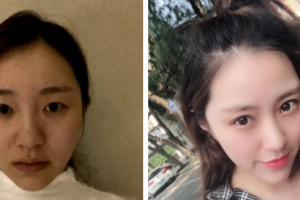 西安貝巢口腔診所張錦鴿整形價格表附眼部綜合案例展示