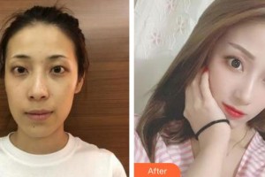 合肥名人眼科醫(yī)院朱美玲整形價(jià)格表附眼部綜合案例展示