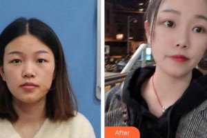 合肥名人眼科醫(yī)院梁祖剛整形價(jià)格表附上瞼提肌案例展示