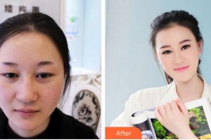 江蘇百年植發(fā)醫(yī)院王燦領整形價格表附植發(fā)案例展示