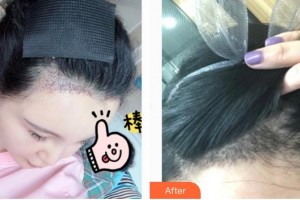 合肥新生植發(fā)醫(yī)院劉維整形價(jià)格表附種植發(fā)際線案例展示