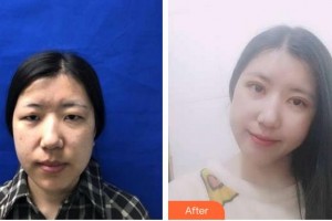 合肥名人眼科醫(yī)院陳林義整形價(jià)格表附眼部案例展示